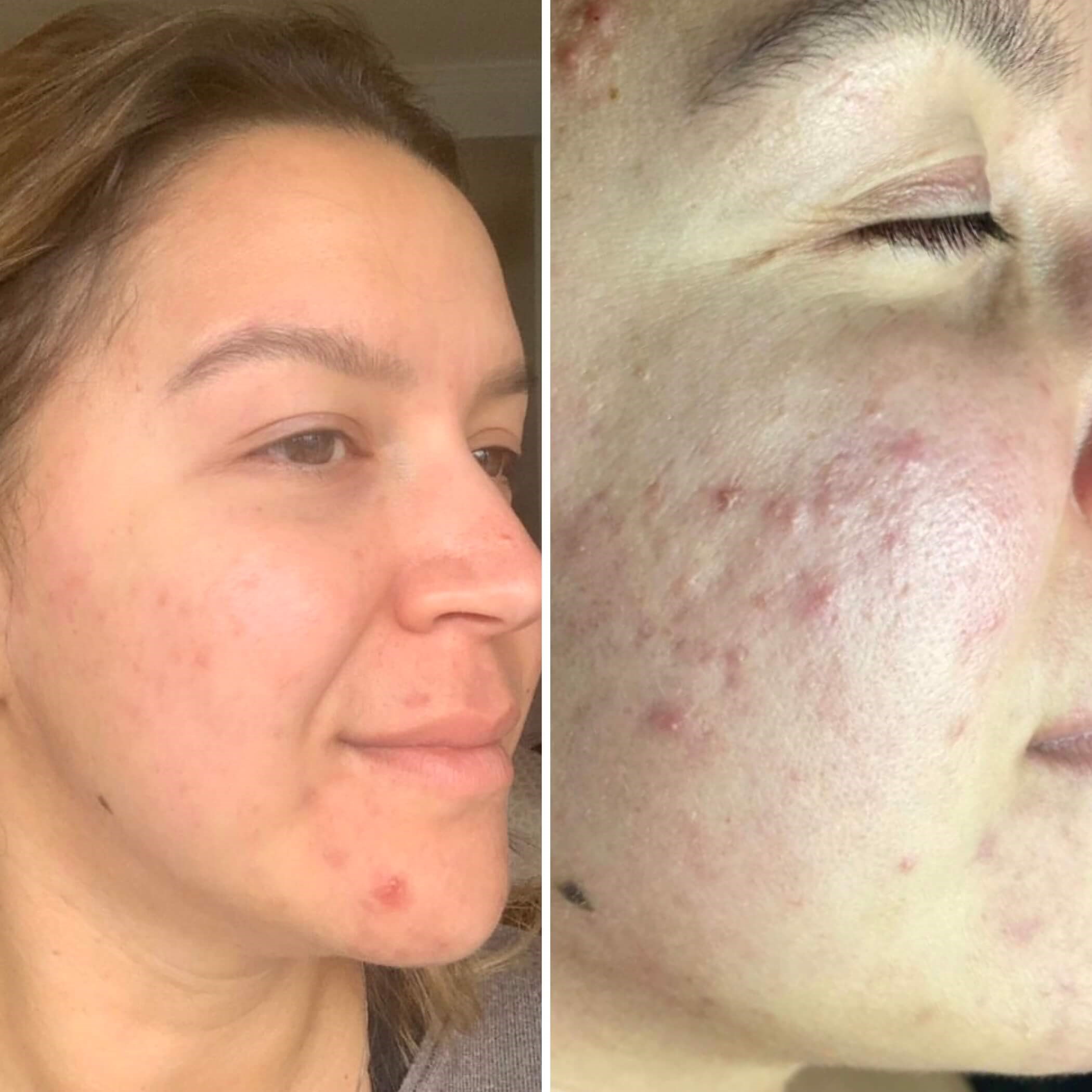 Acne treatment - Before and Af
