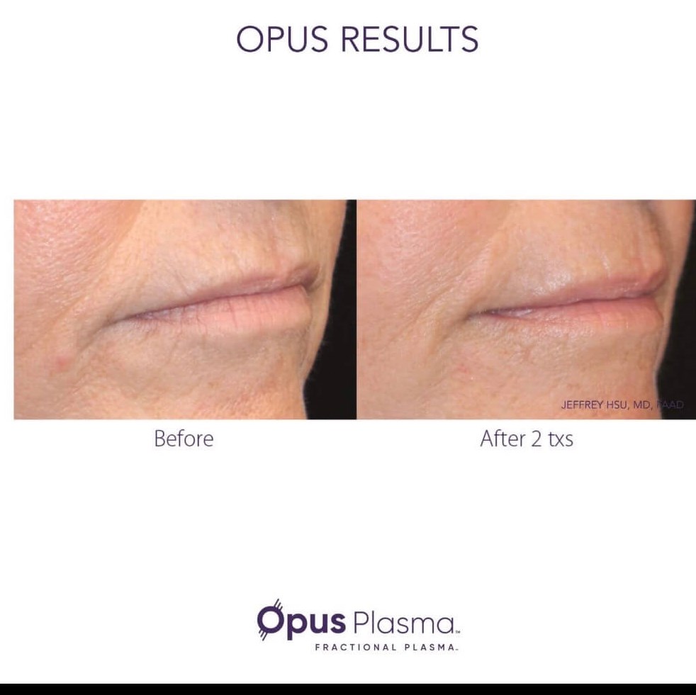 Before and after Opus Plasma t