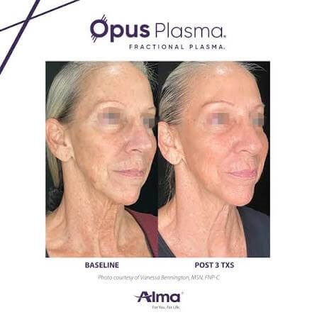 Before and after Opus Plasma f